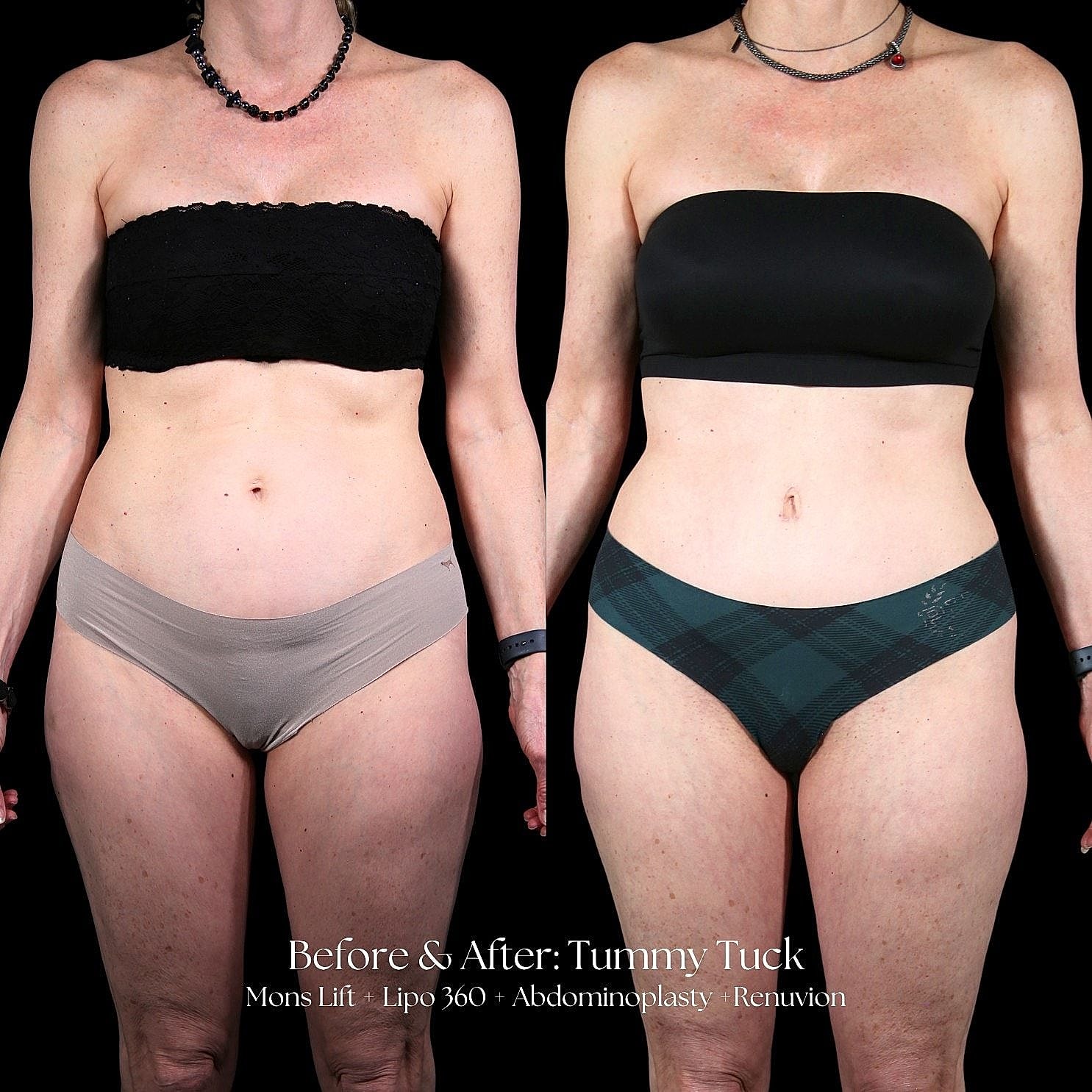 Before and after tummy tuck transformation image