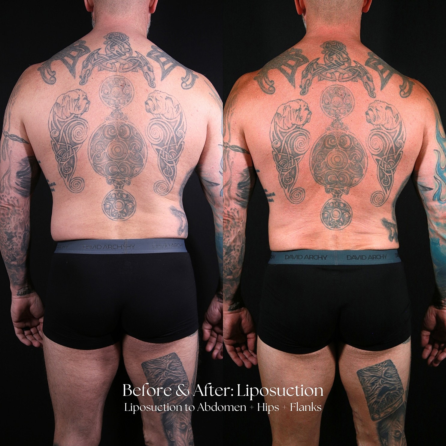 Liposuction  Before & After