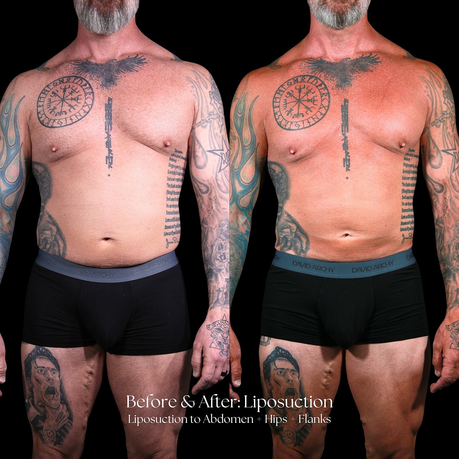 Liposuction  Before & After