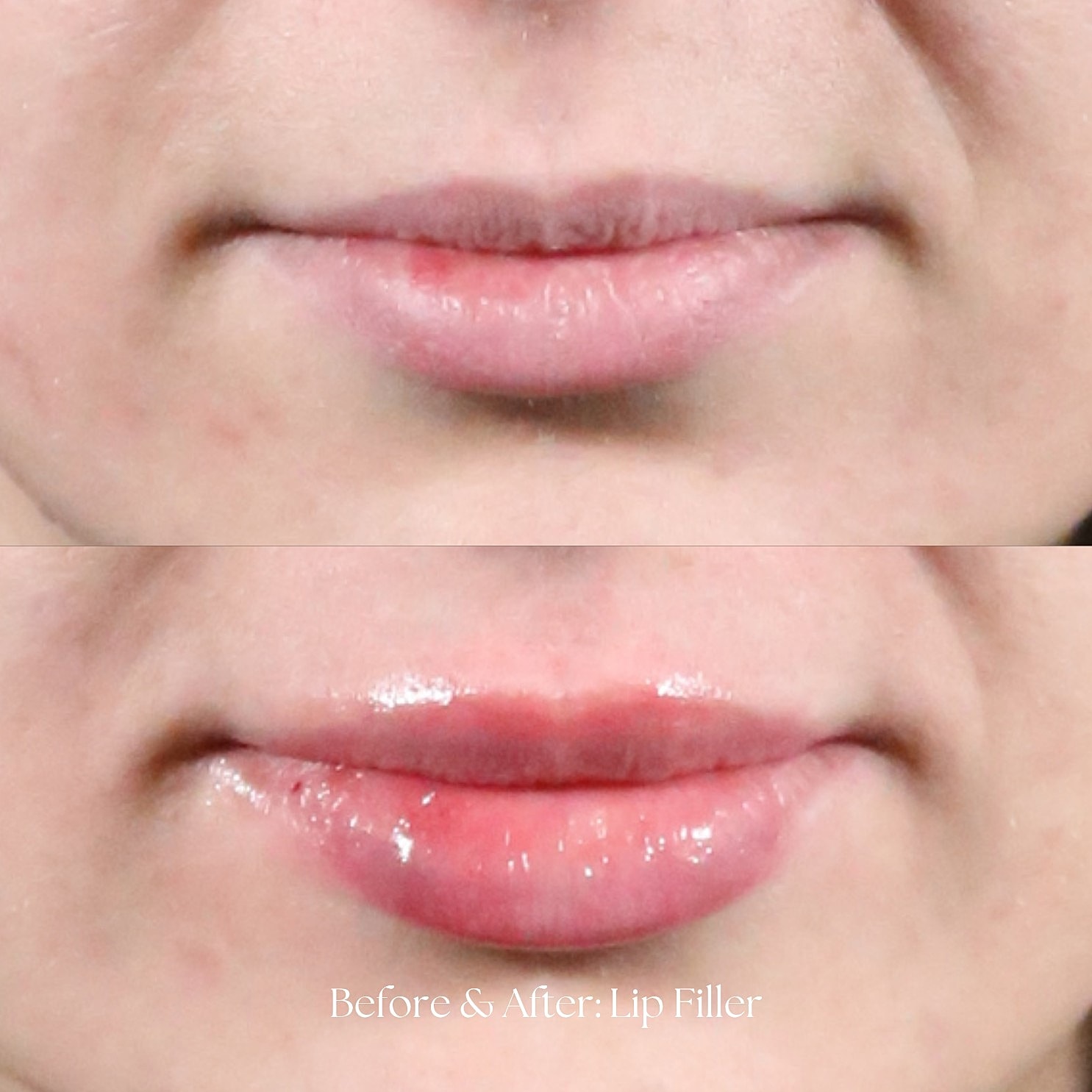 Lip Filler Before & After