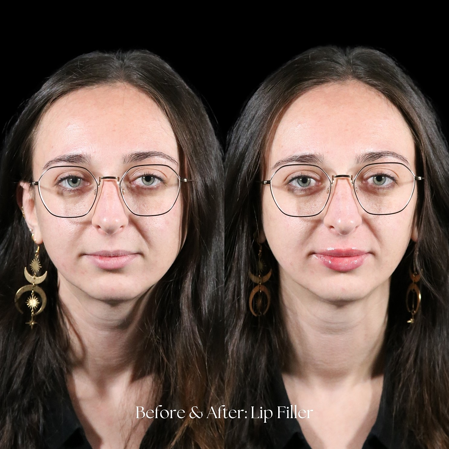 Lip Filler Before & After