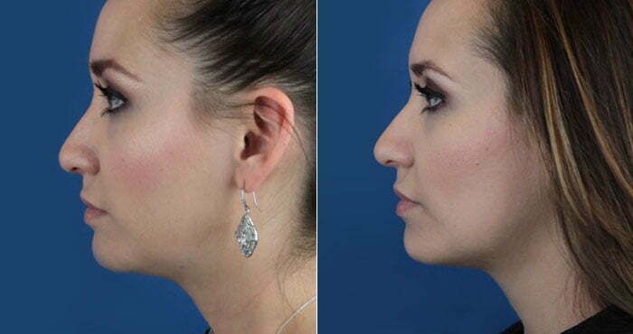 Kybella Before & After