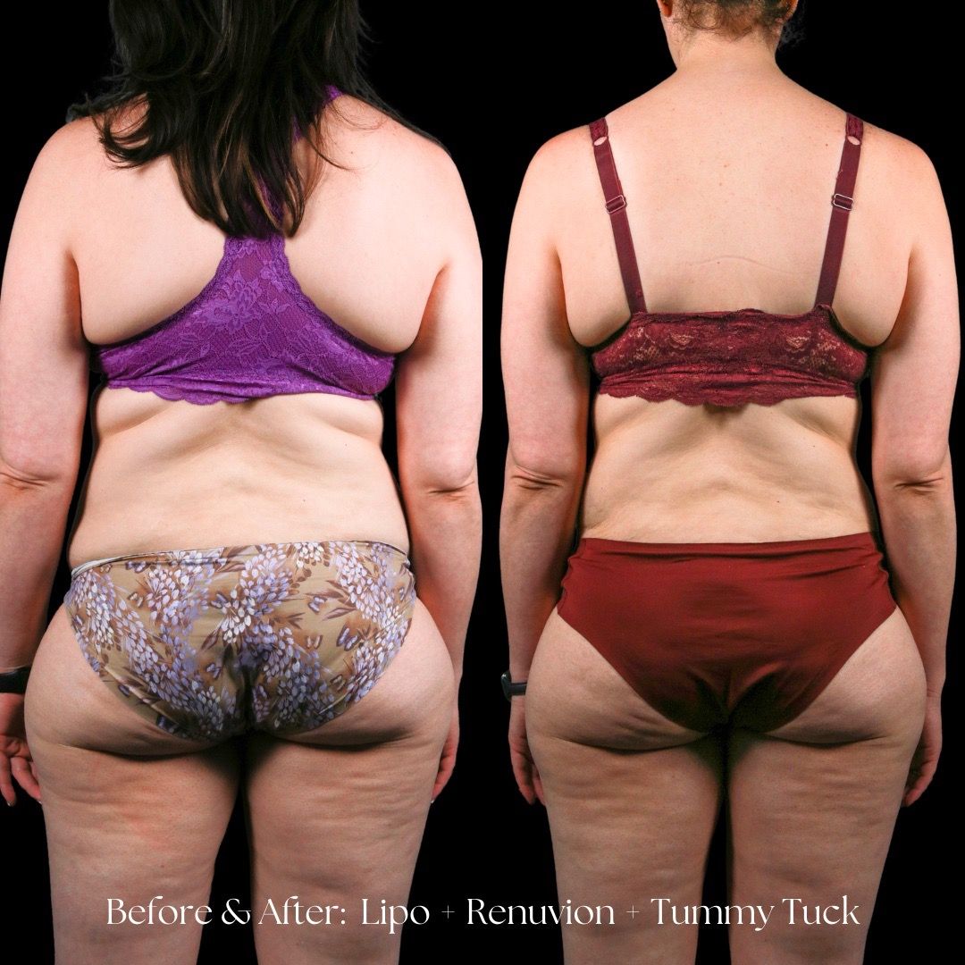 Renuvion Before & After