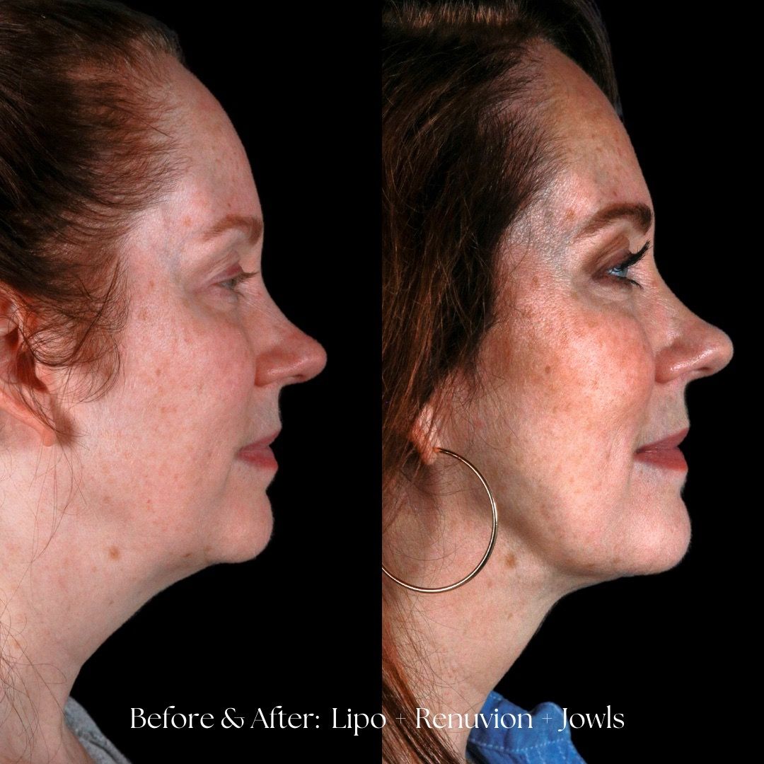 Renuvion Before & After