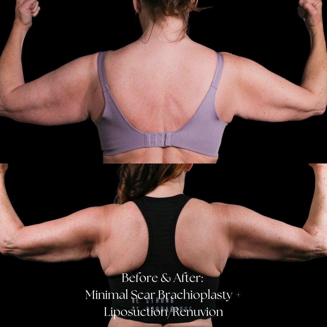 Renuvion Before & After