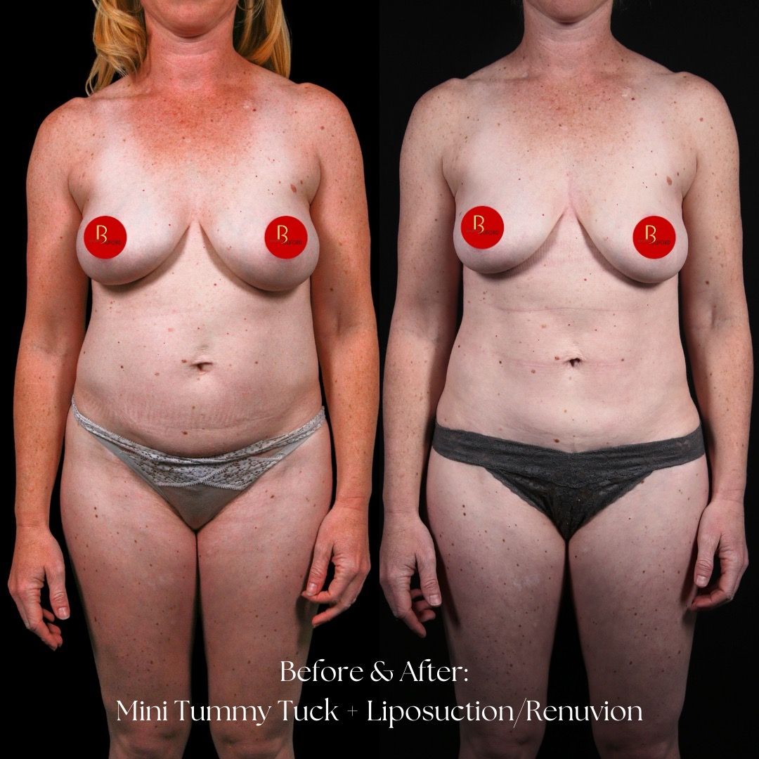 Renuvion Before & After