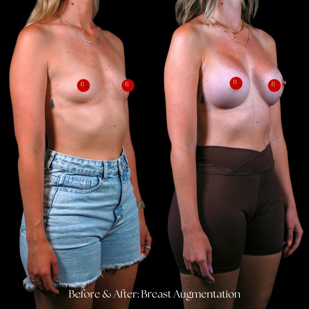 Breast Augmentation Before & After