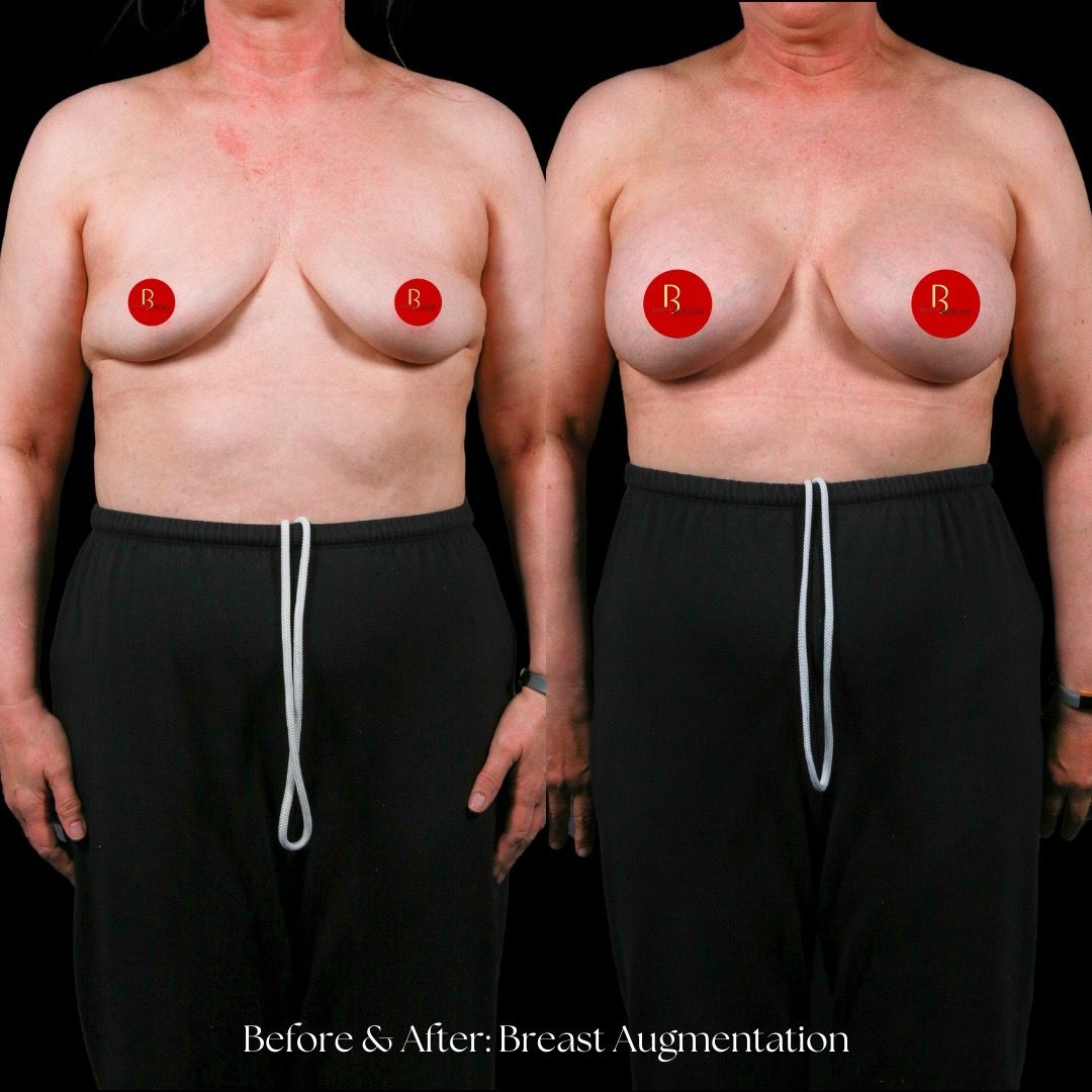 Breast Augmentation Before & After