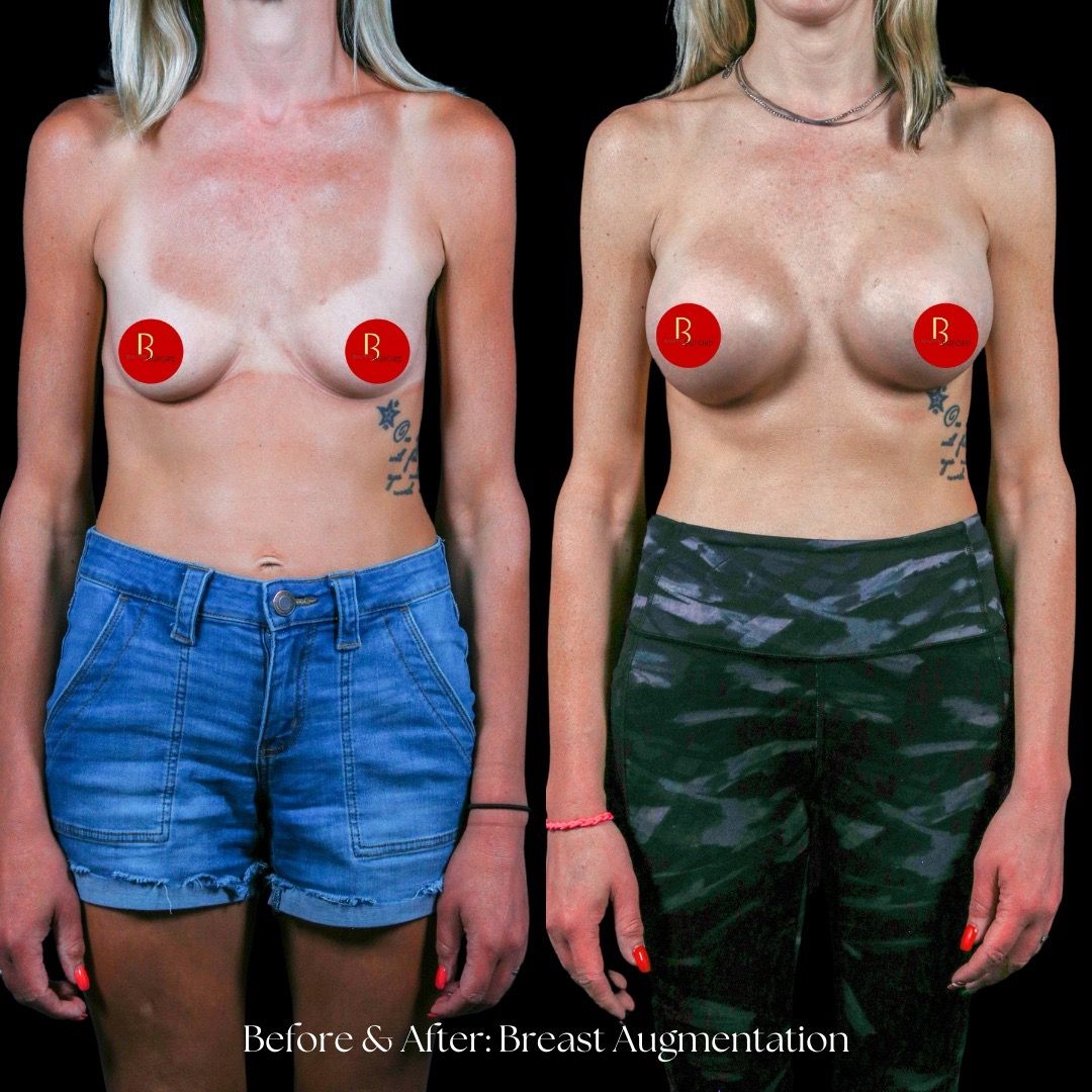 Breast Augmentation Before & After