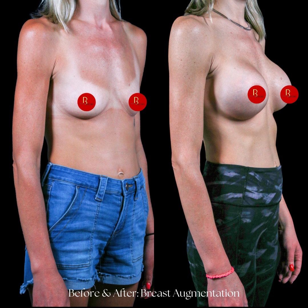 Breast Augmentation Before & After