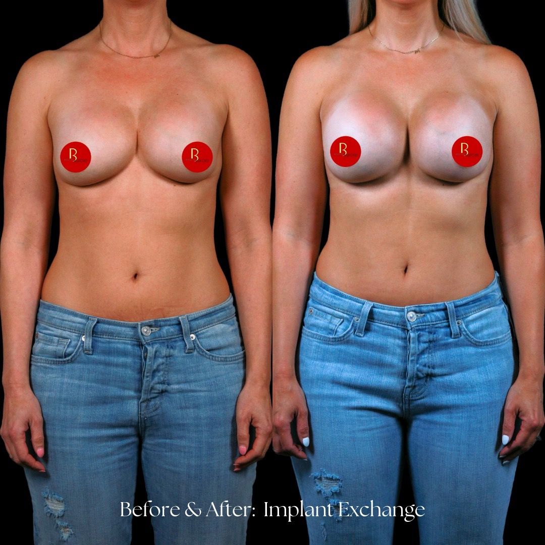 Breast Augmentation Before & After