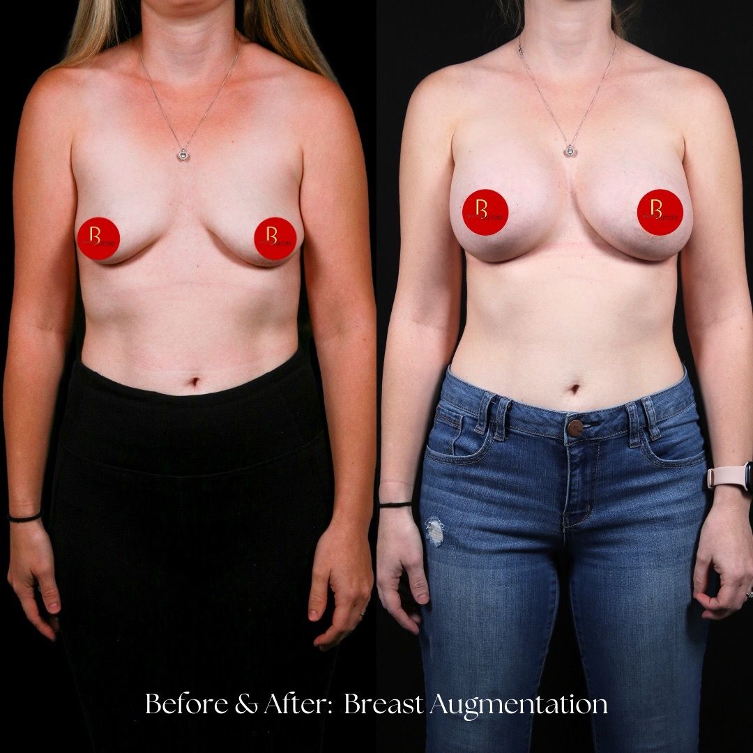 Breast Augmentation Before & After