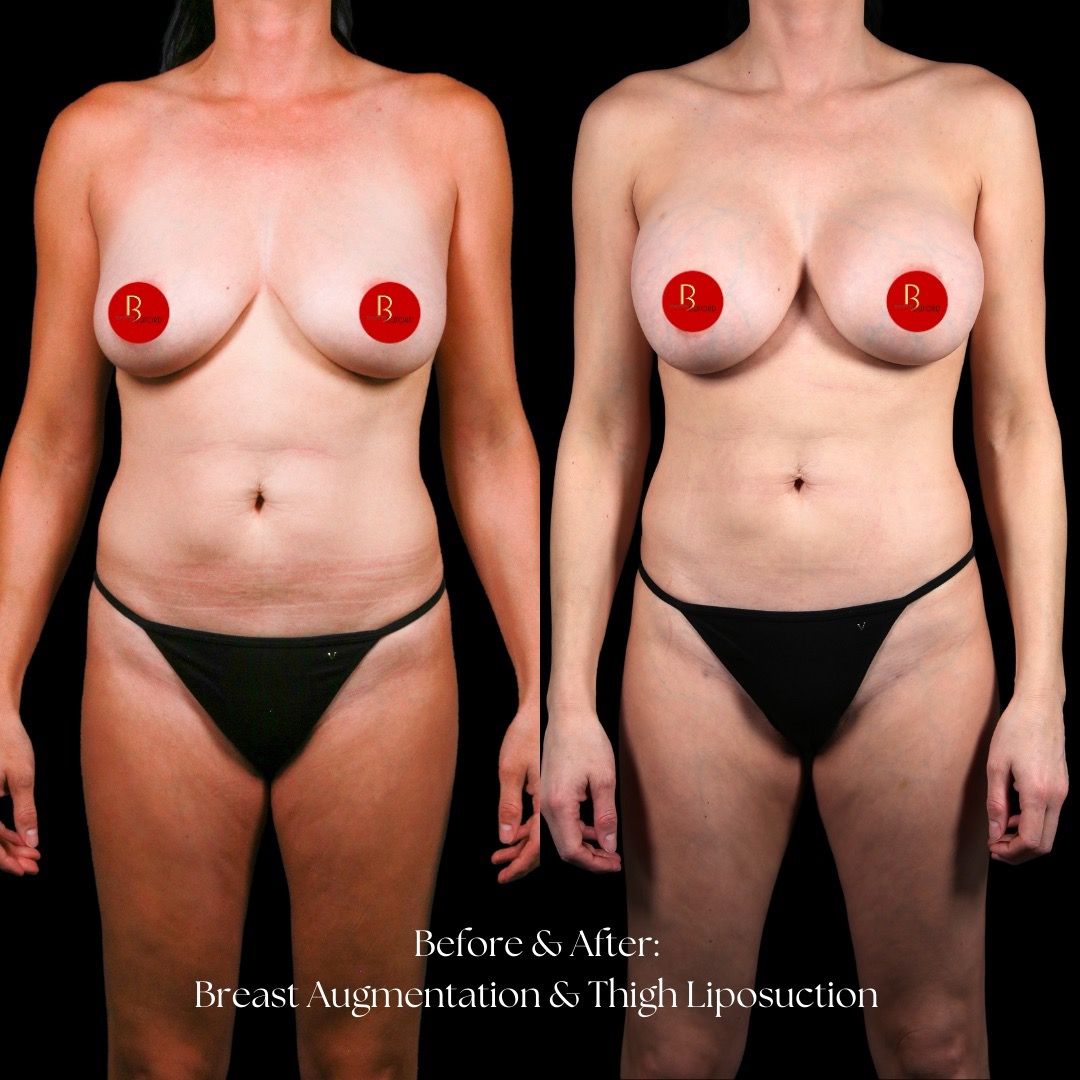 Breast Augmentation Before & After
