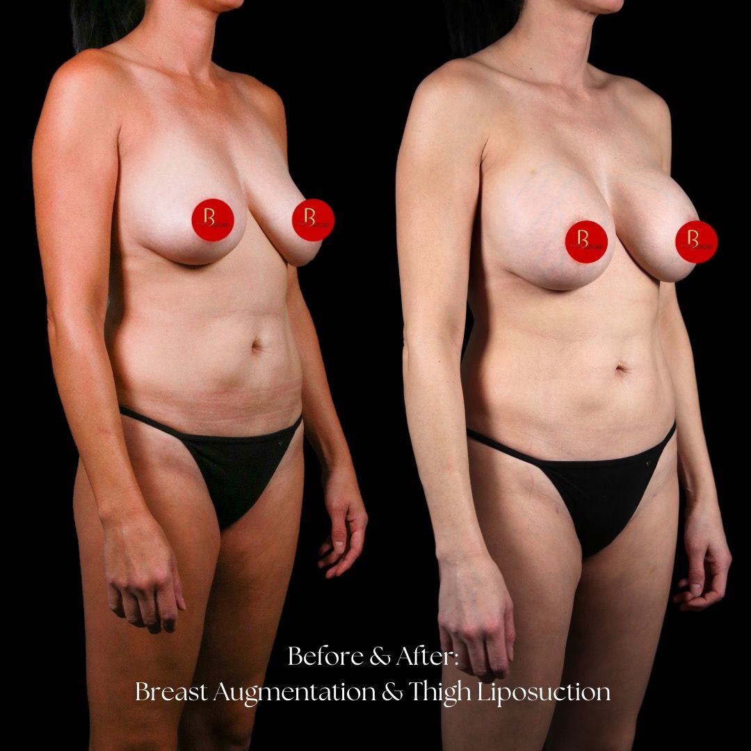Breast Augmentation Before & After
