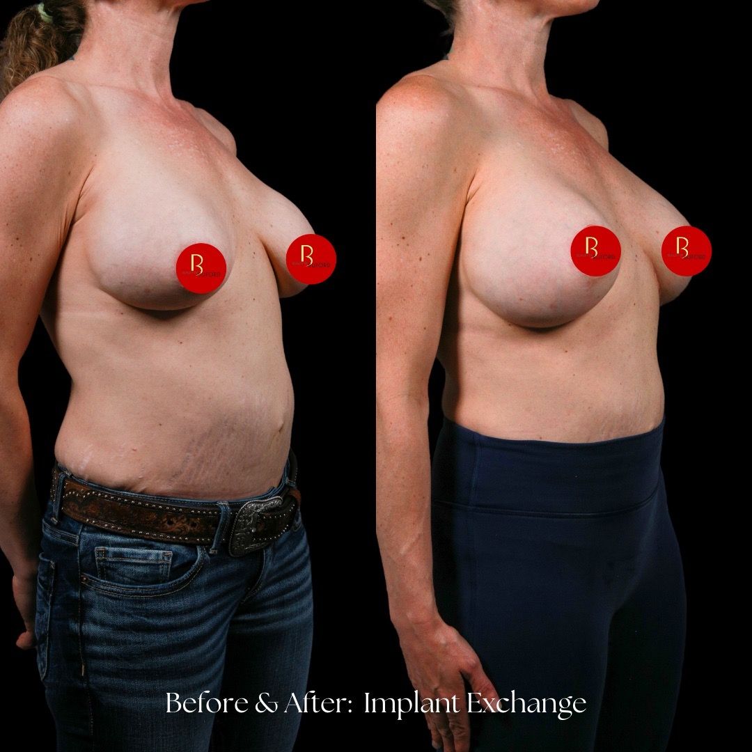 Breast Augmentation Before & After