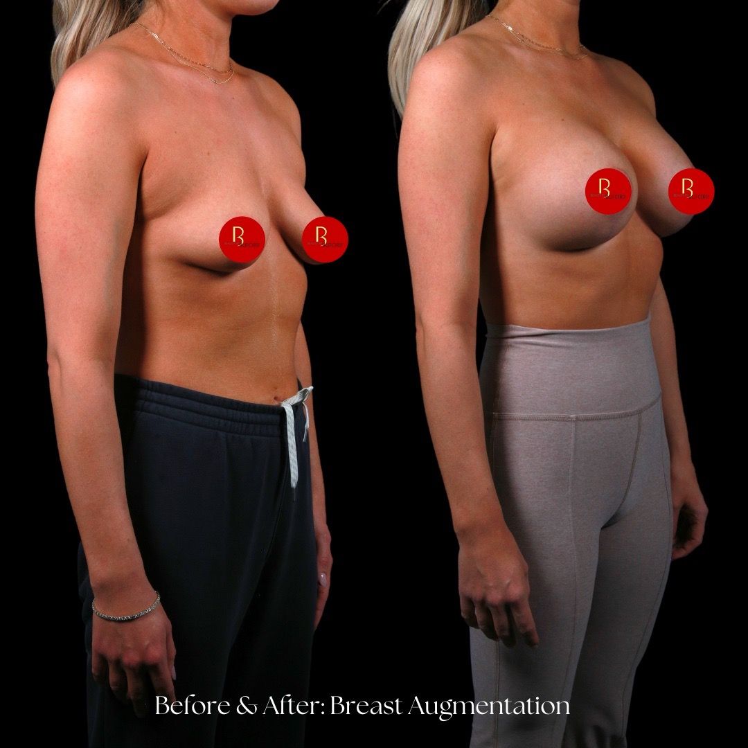 Breast Augmentation Before & After