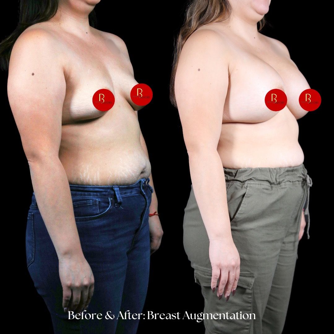 Breast Augmentation Before & After