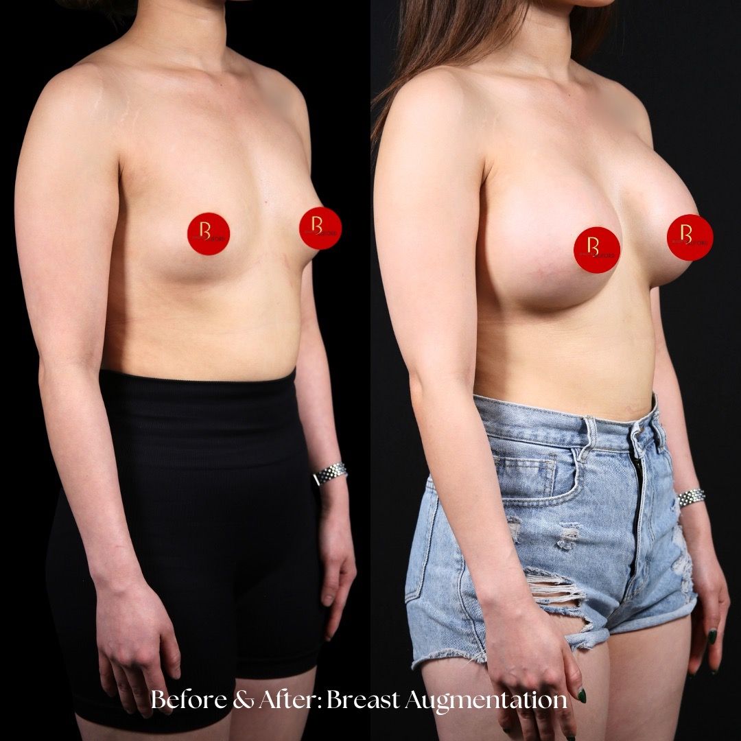 Breast Augmentation Before & After