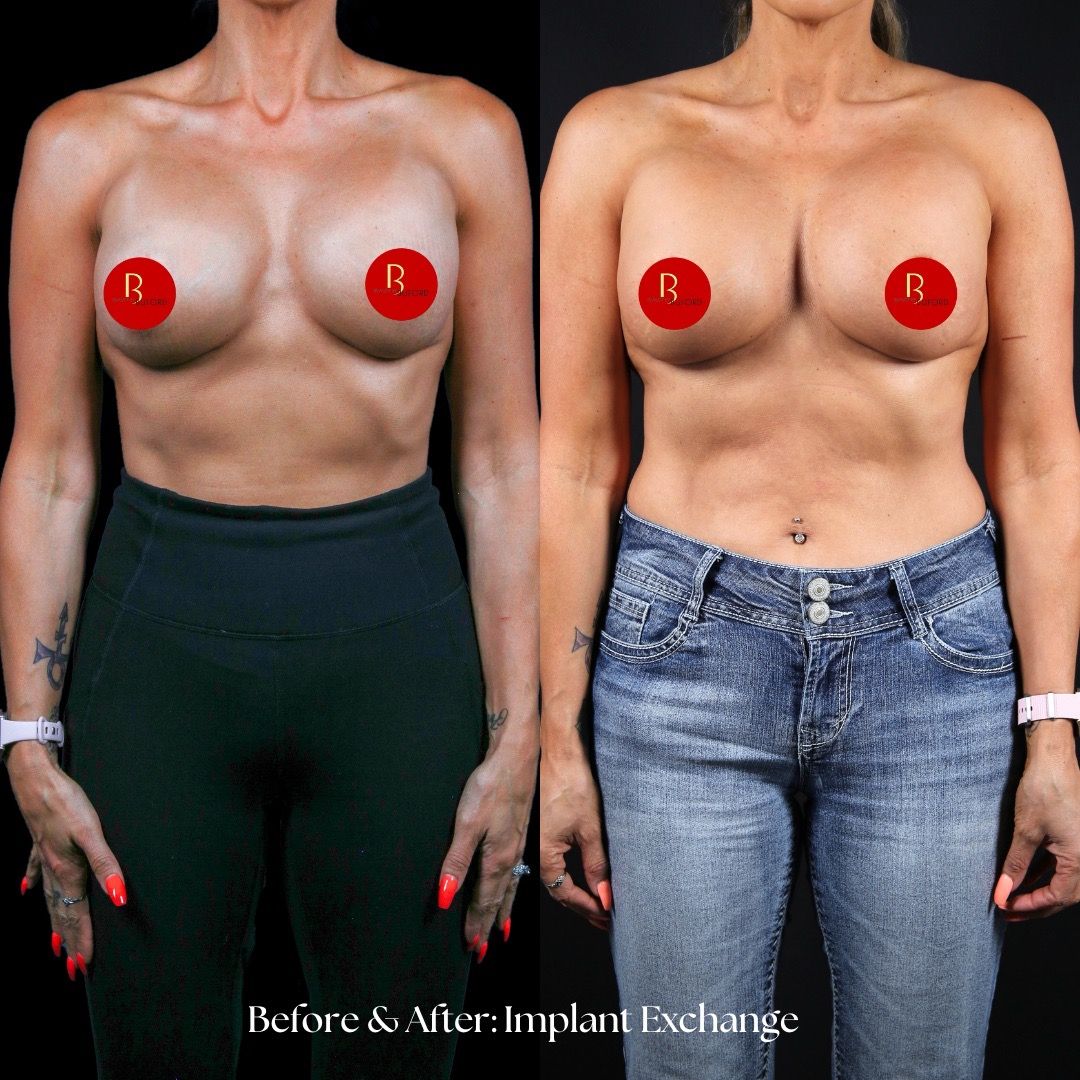 Breast Augmentation Before & After