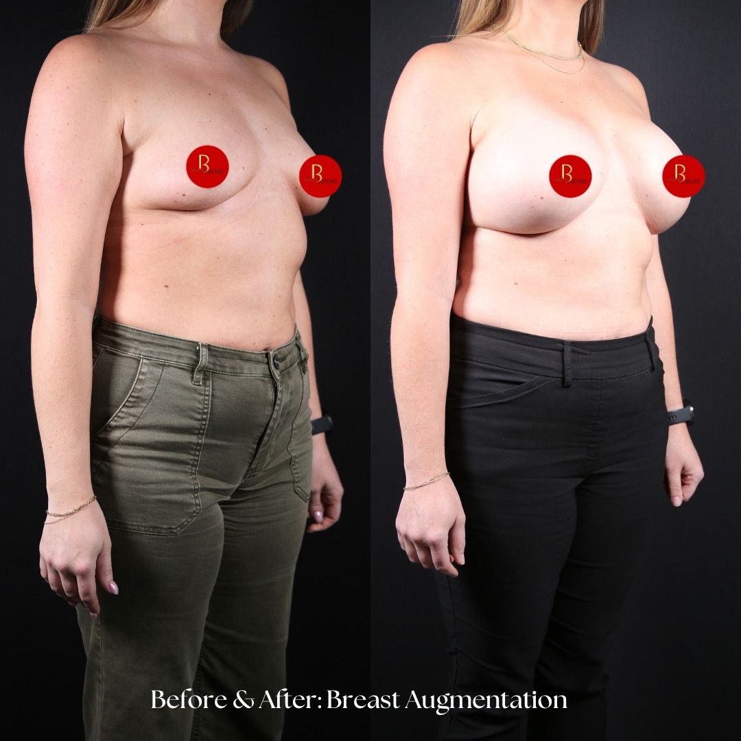 Breast Augmentation Before & After