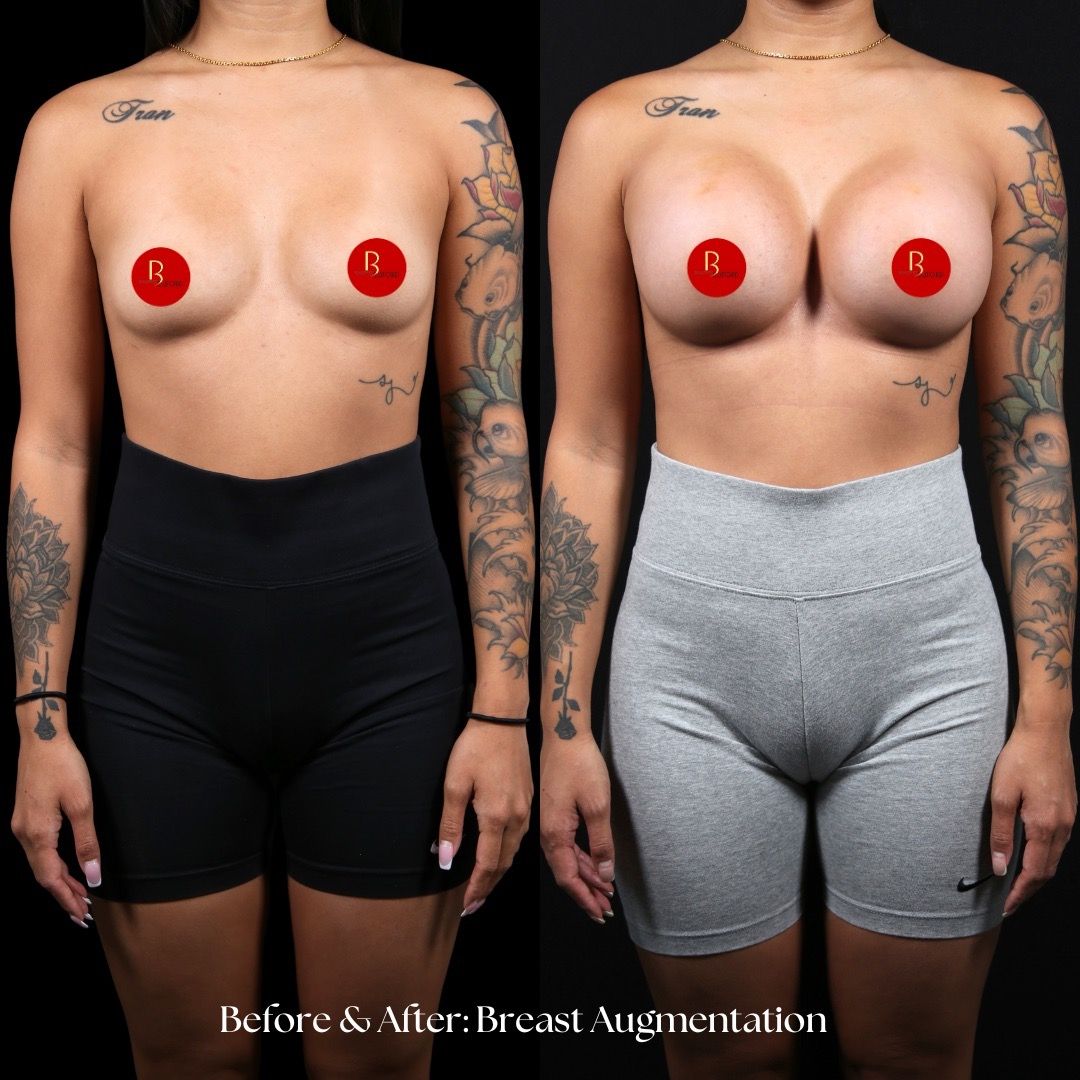 Breast Augmentation Before & After