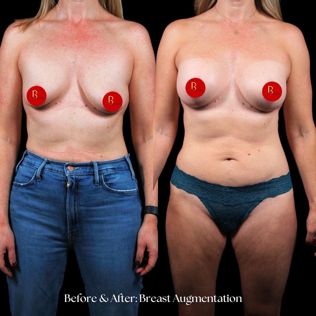 Breast Augmentation Before & After