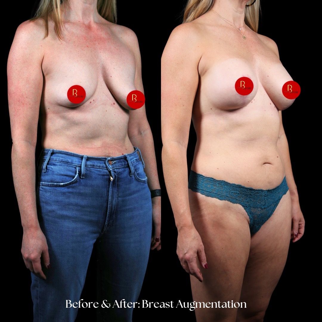 Breast Augmentation Before & After