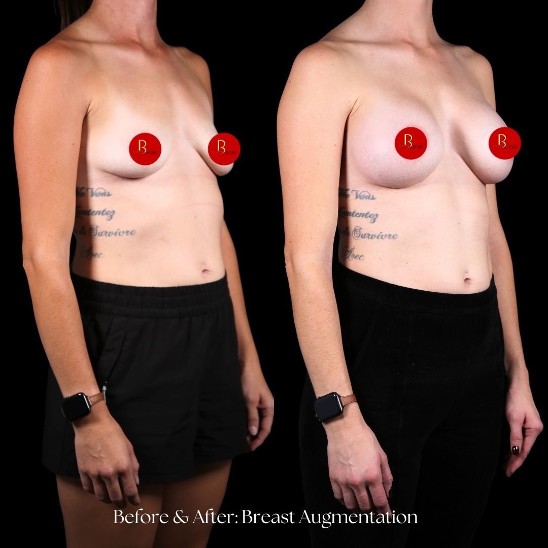 Breast Augmentation Before & After