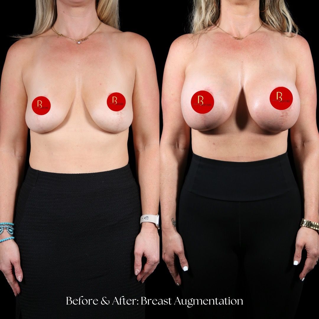 Breast Augmentation Before & After