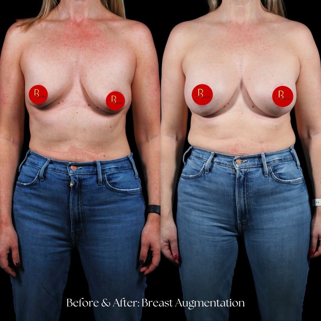Breast Augmentation Before & After