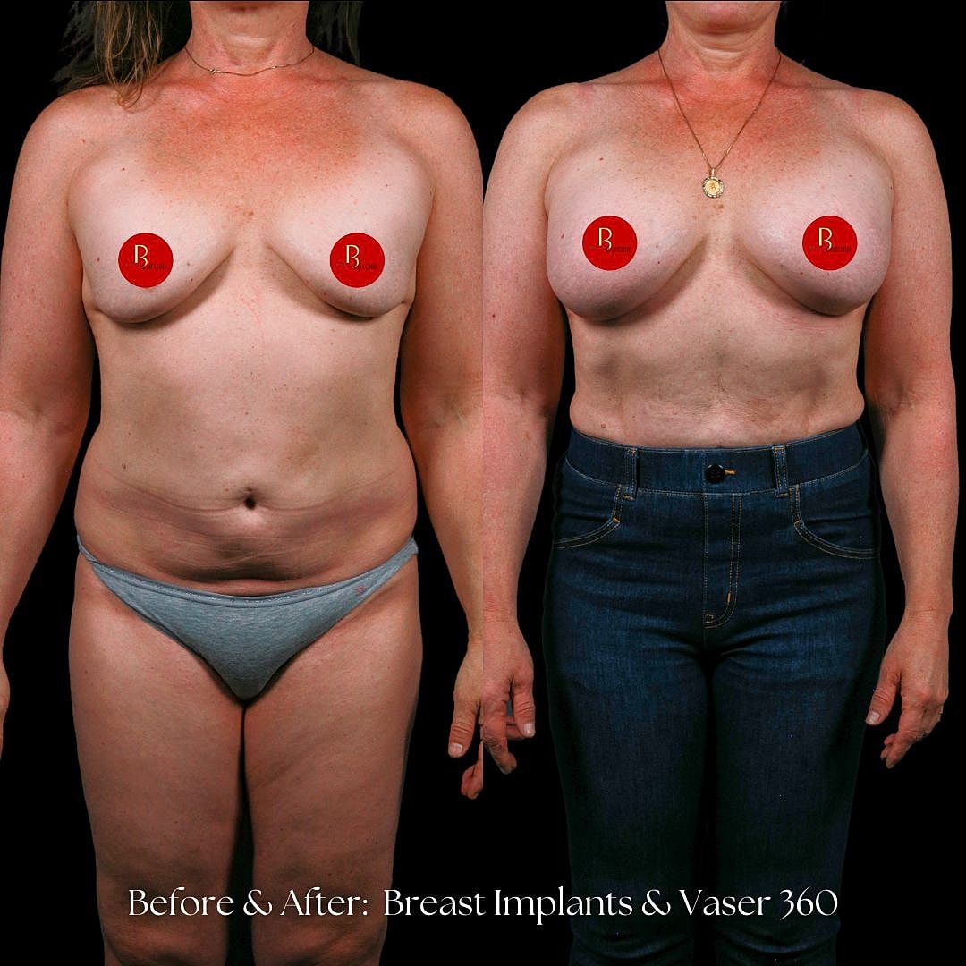 Before and after breast augmentation transformation photo