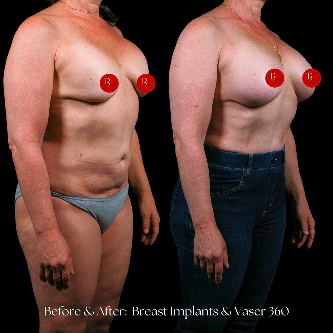 Before and after breast enhancement transformation photo.