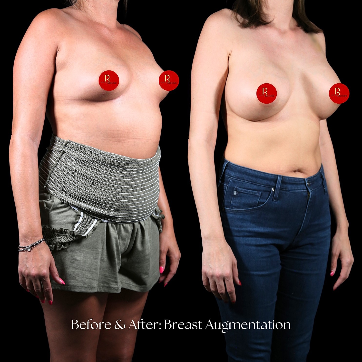 Breast Augmentation Before & After