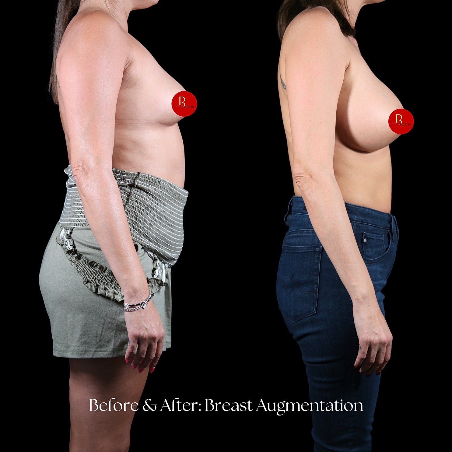 Breast Augmentation Before & After