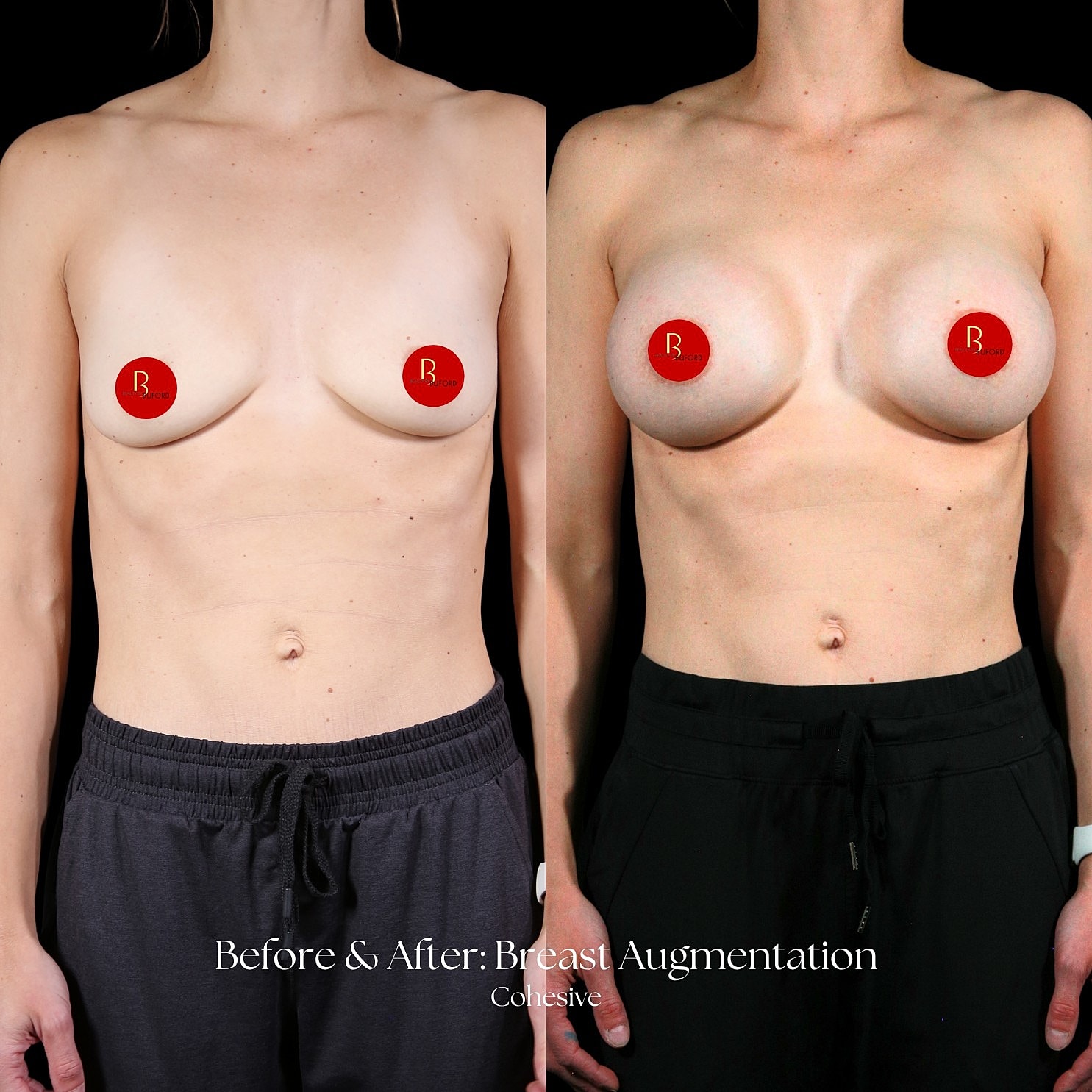 Breast Augmentation Before & After
