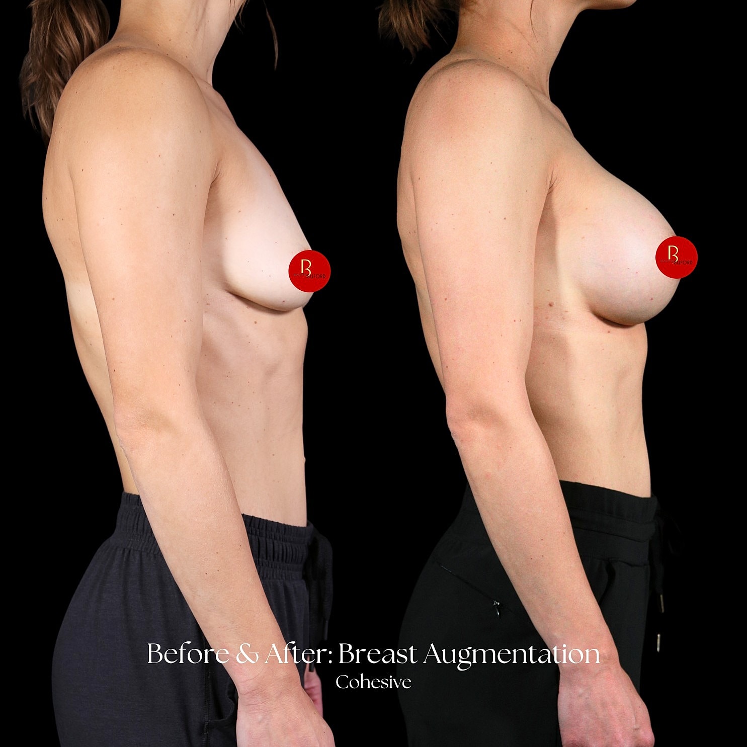 Breast Augmentation Before & After