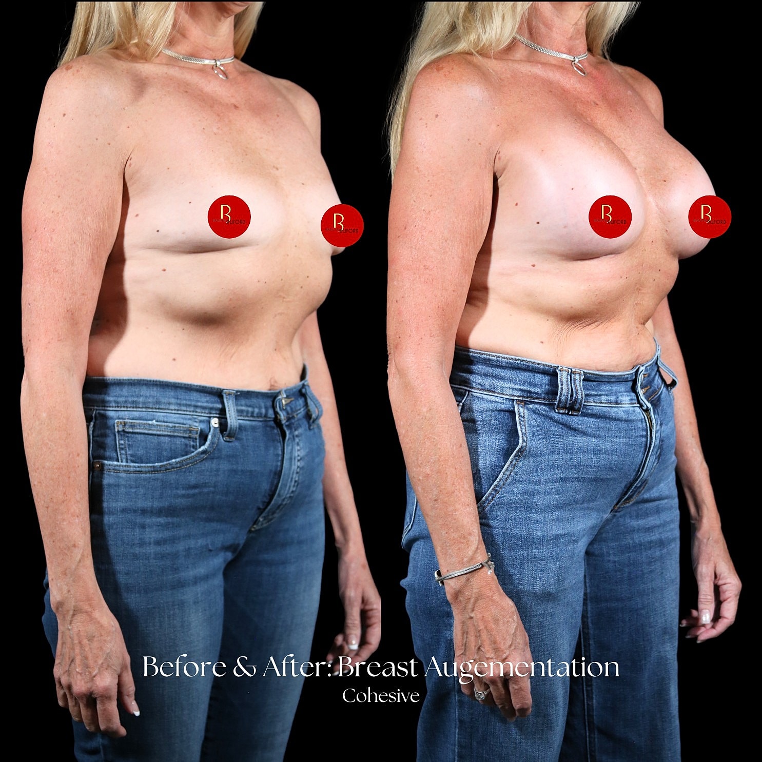 Breast Augmentation Before & After