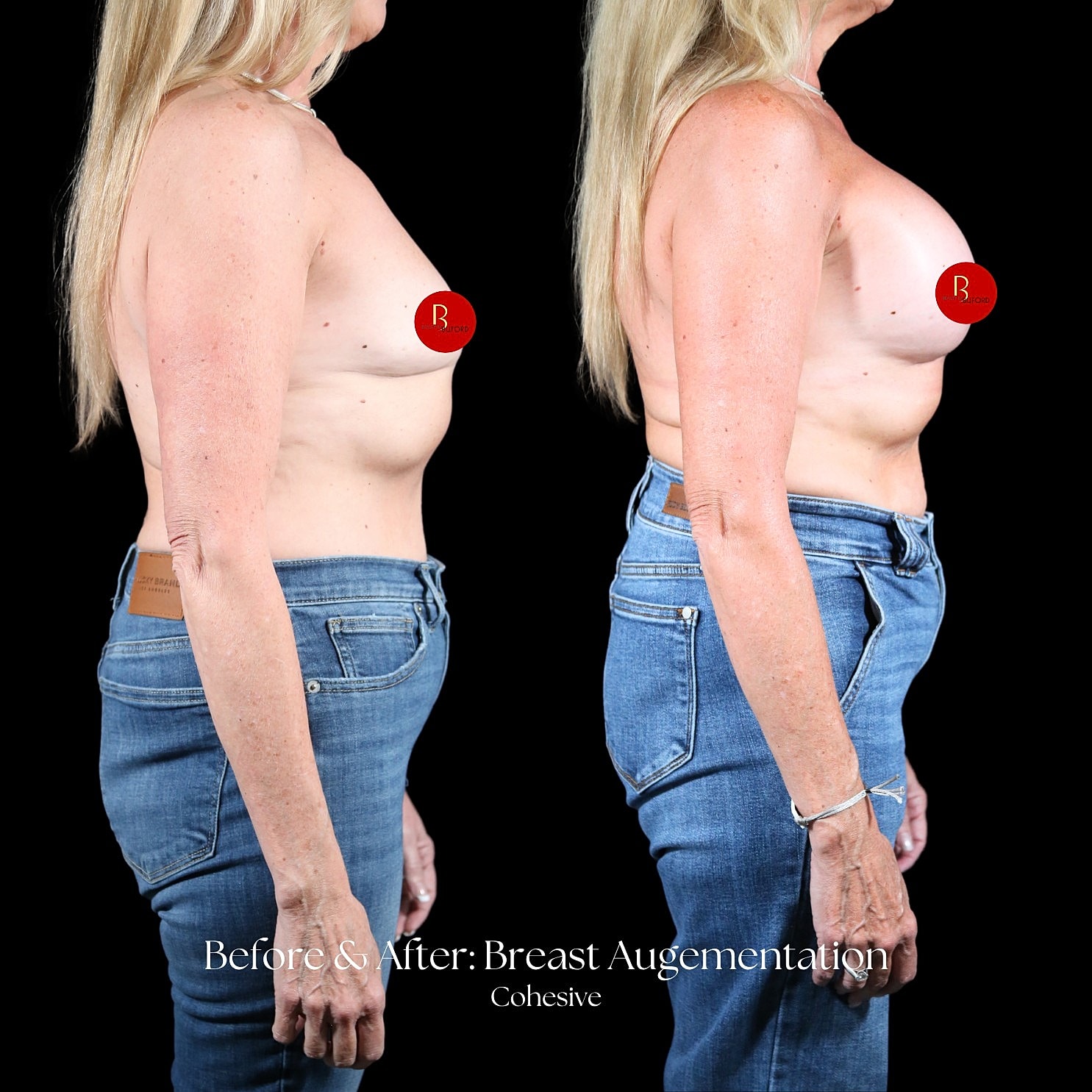 Breast Augmentation Before & After