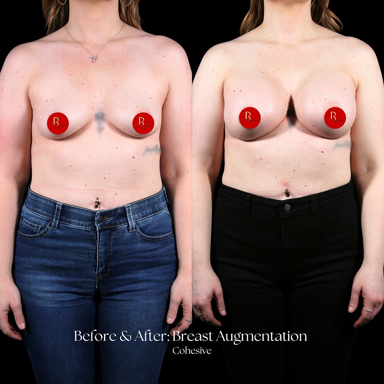 Breast Augmentation Before & After