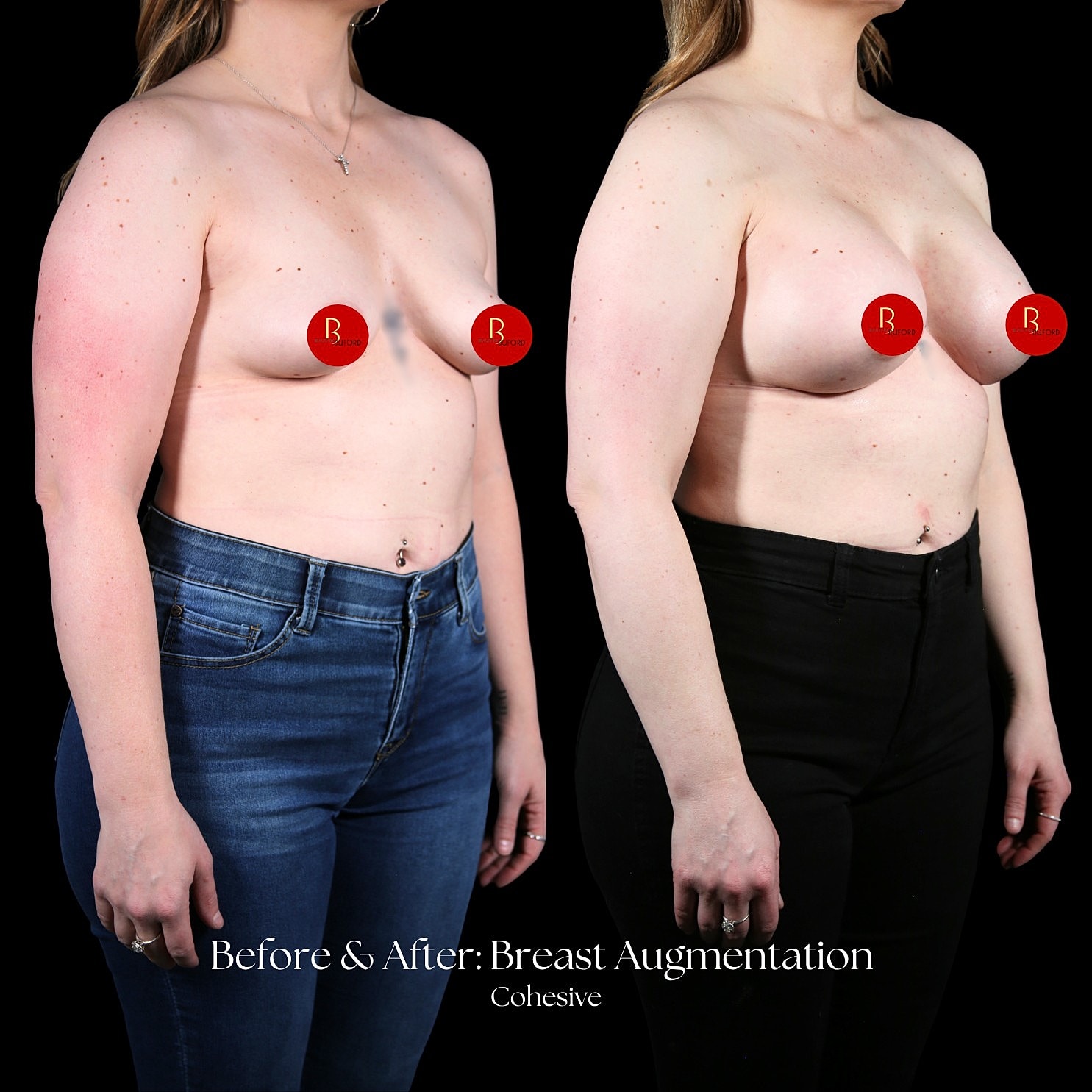 Breast Augmentation Before & After