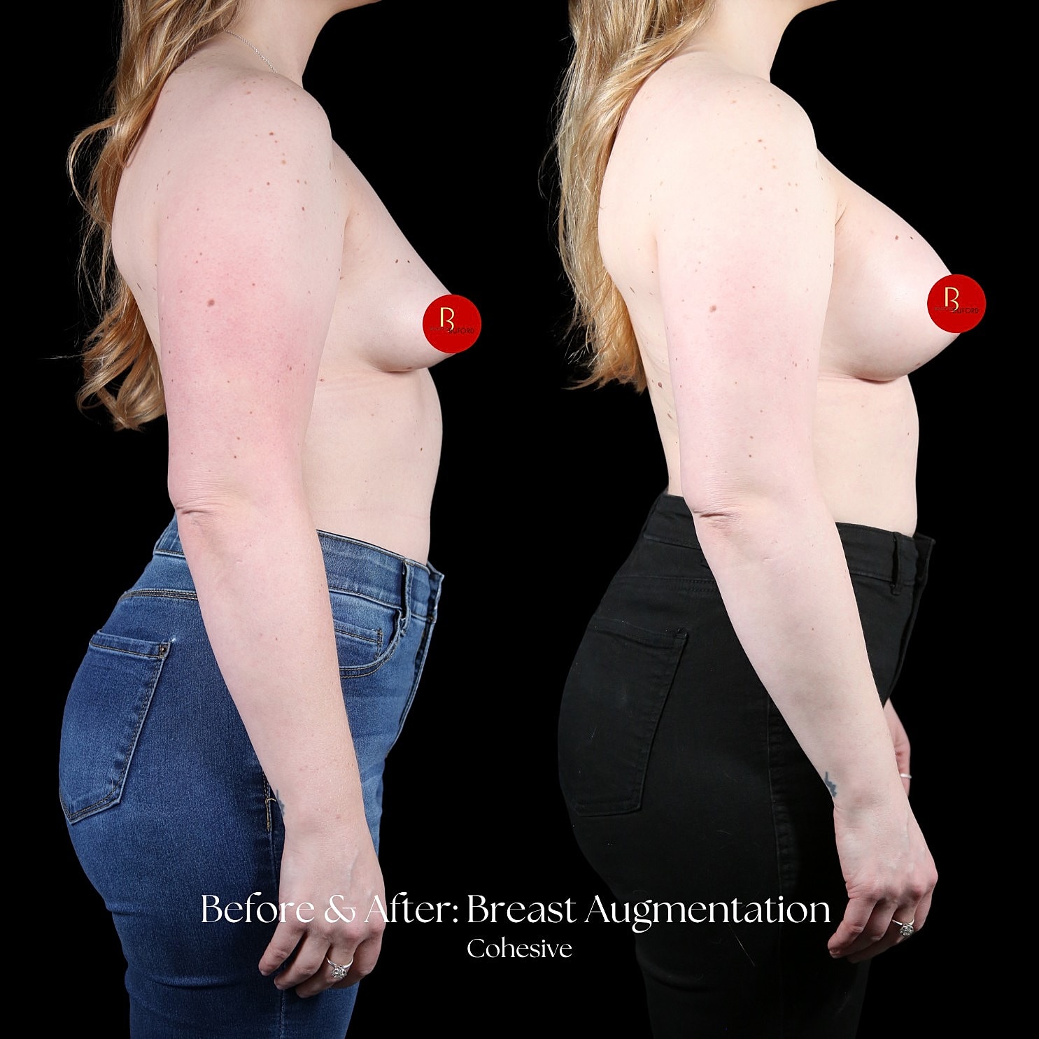 Breast Augmentation Before & After