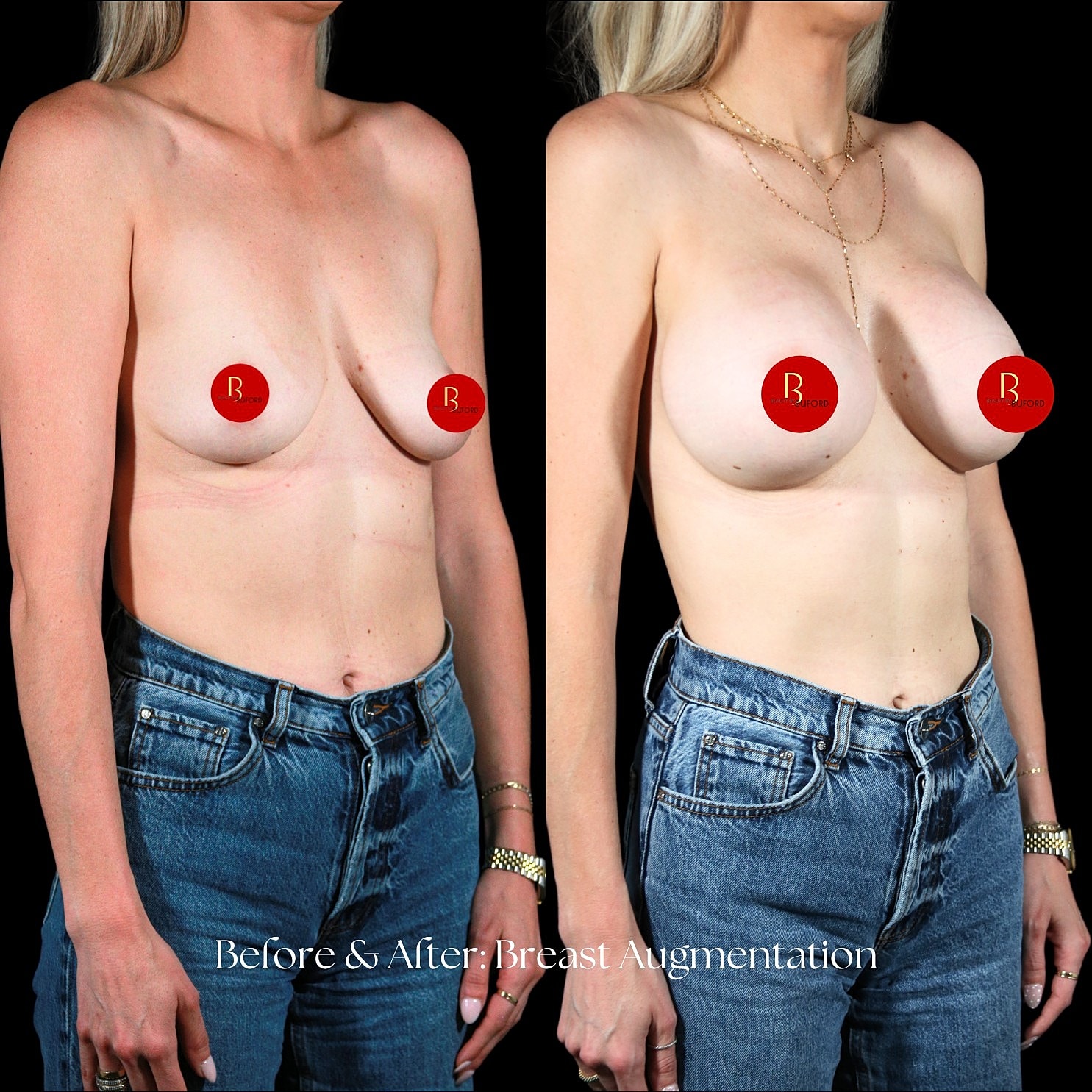 Breast Augmentation Before & After