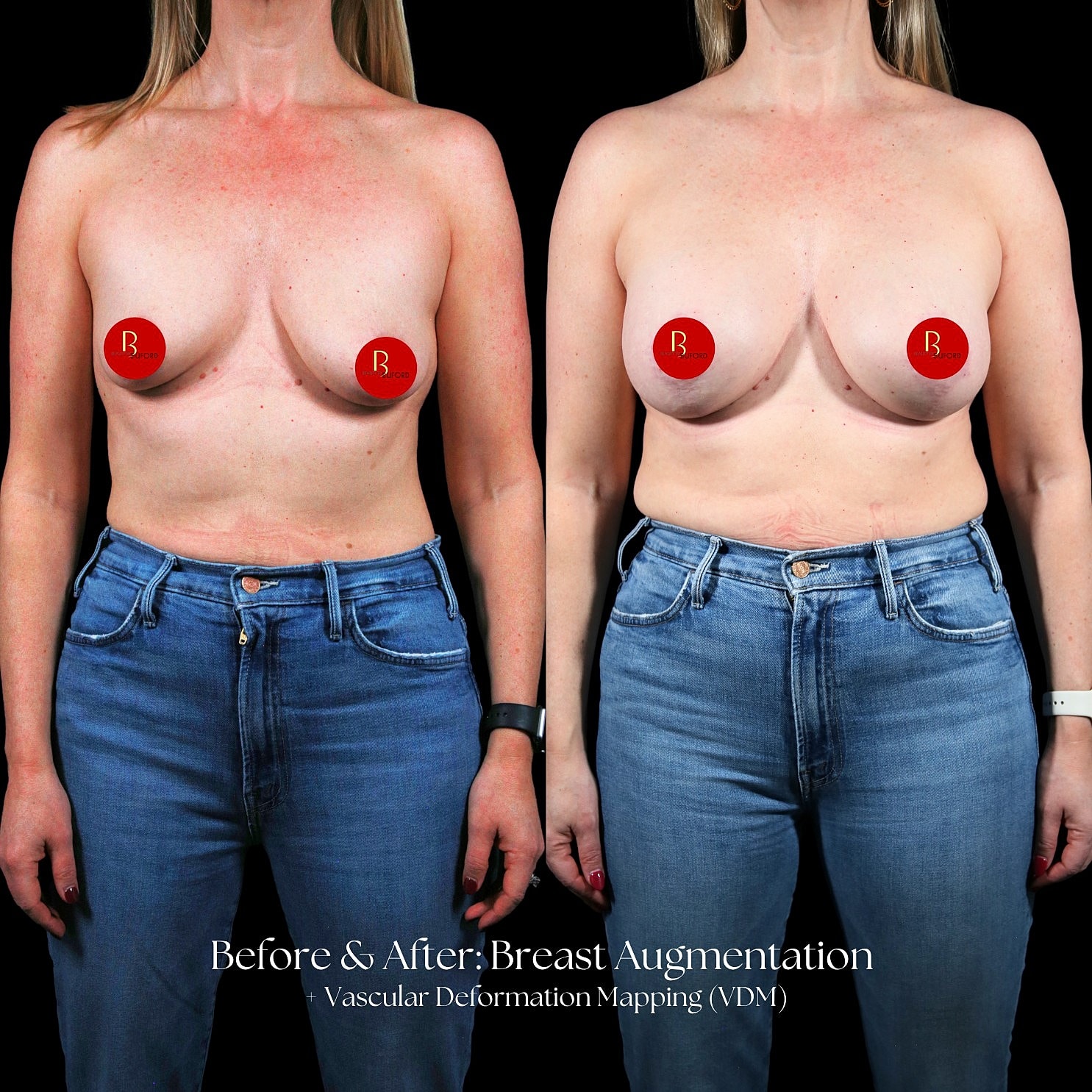 Breast Augmentation Before & After
