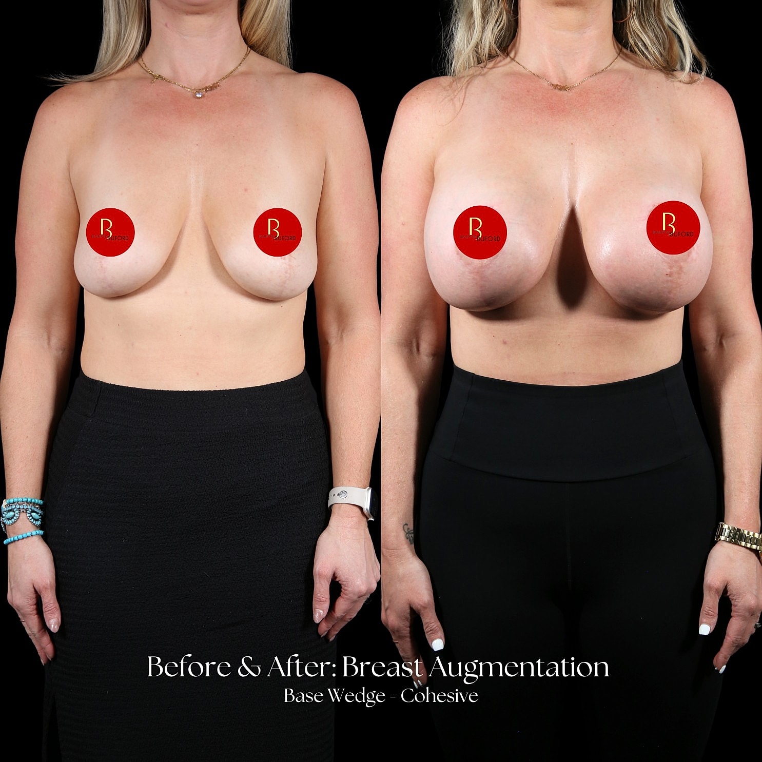Breast Augmentation Before & After