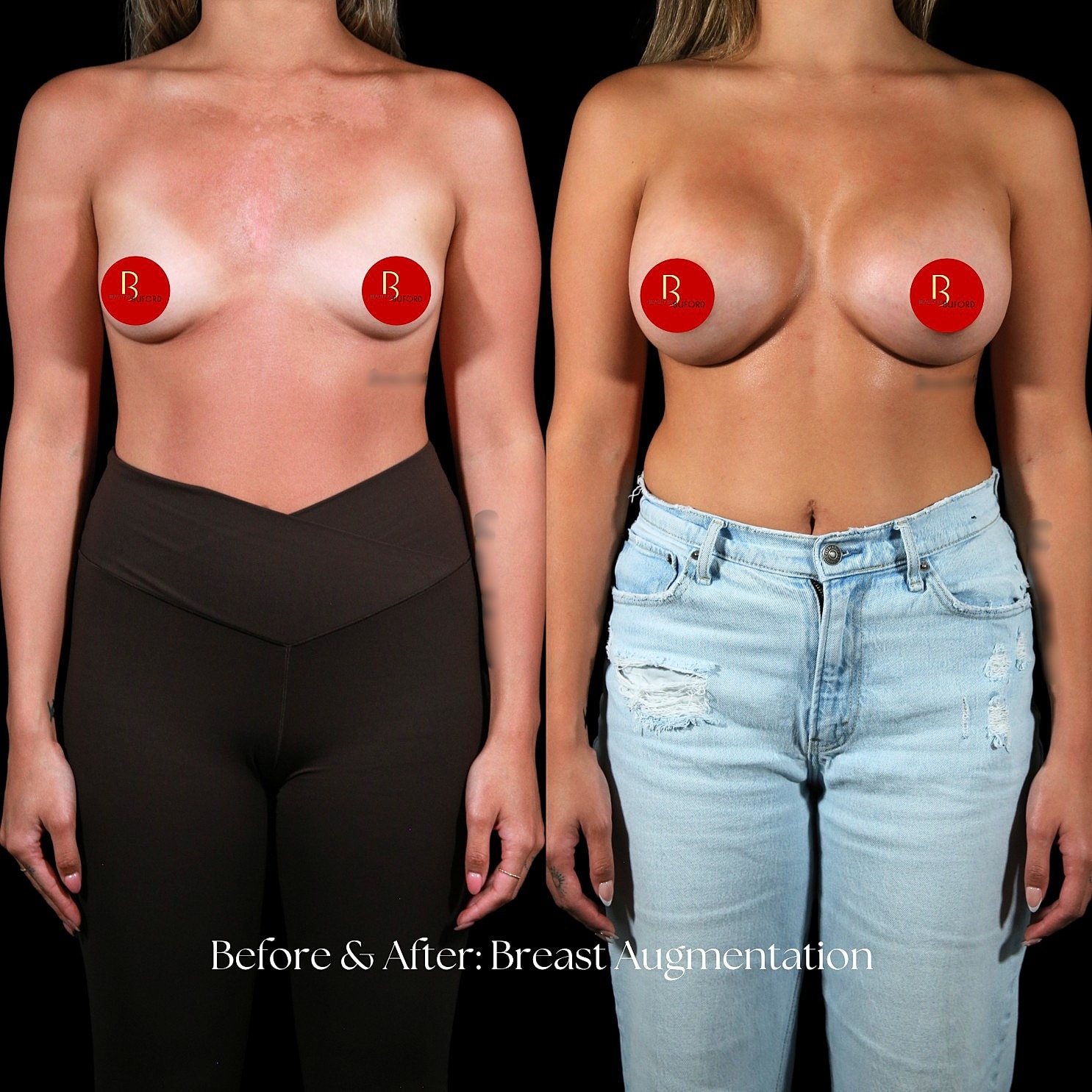 Breast Augmentation Before & After