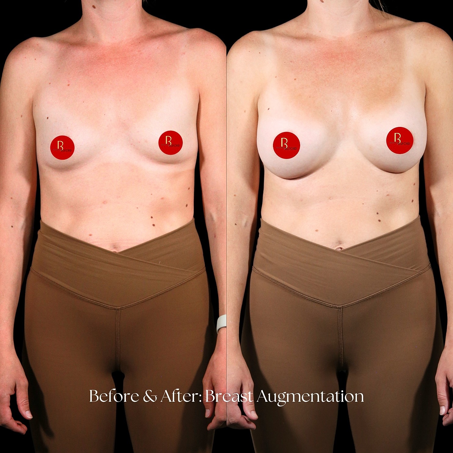 Breast Augmentation Before & After