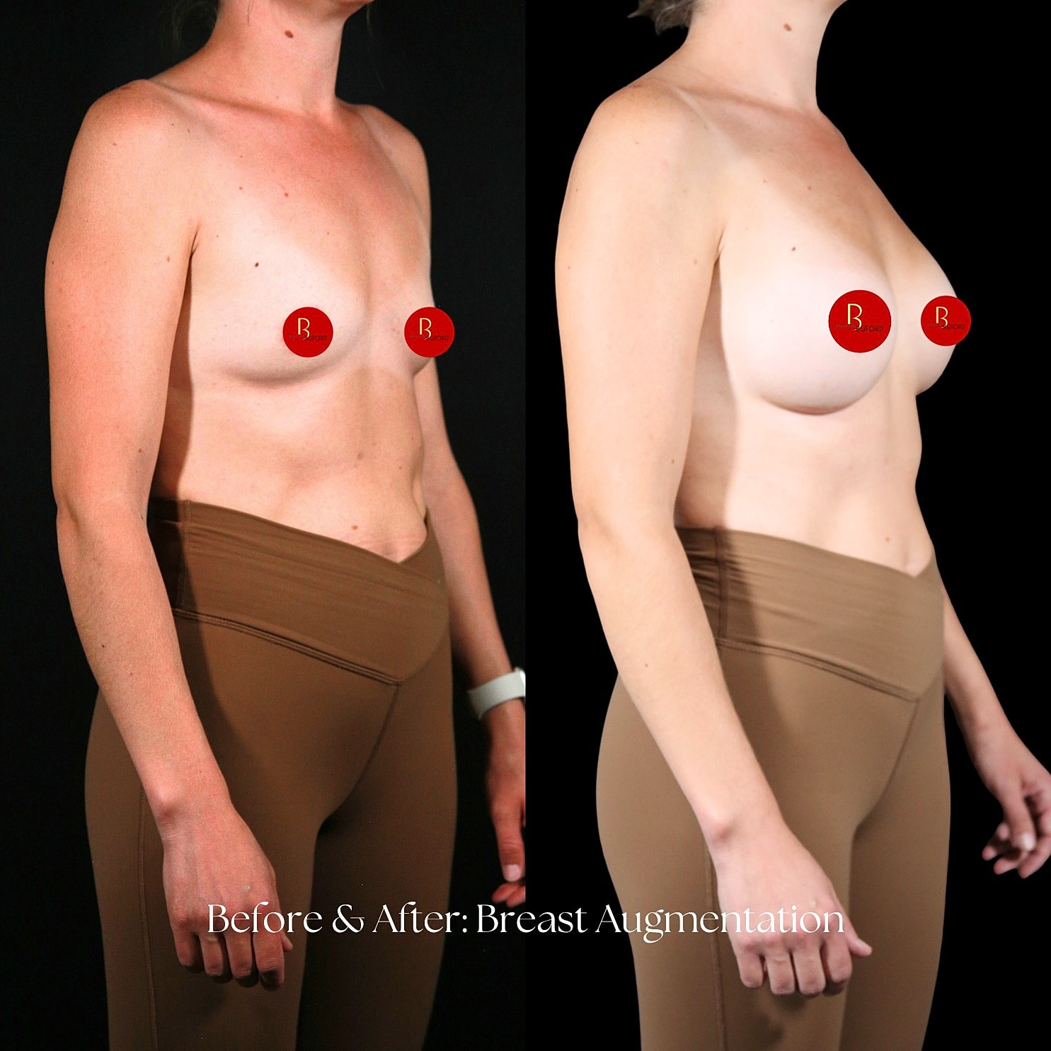 Breast Augmentation Before & After