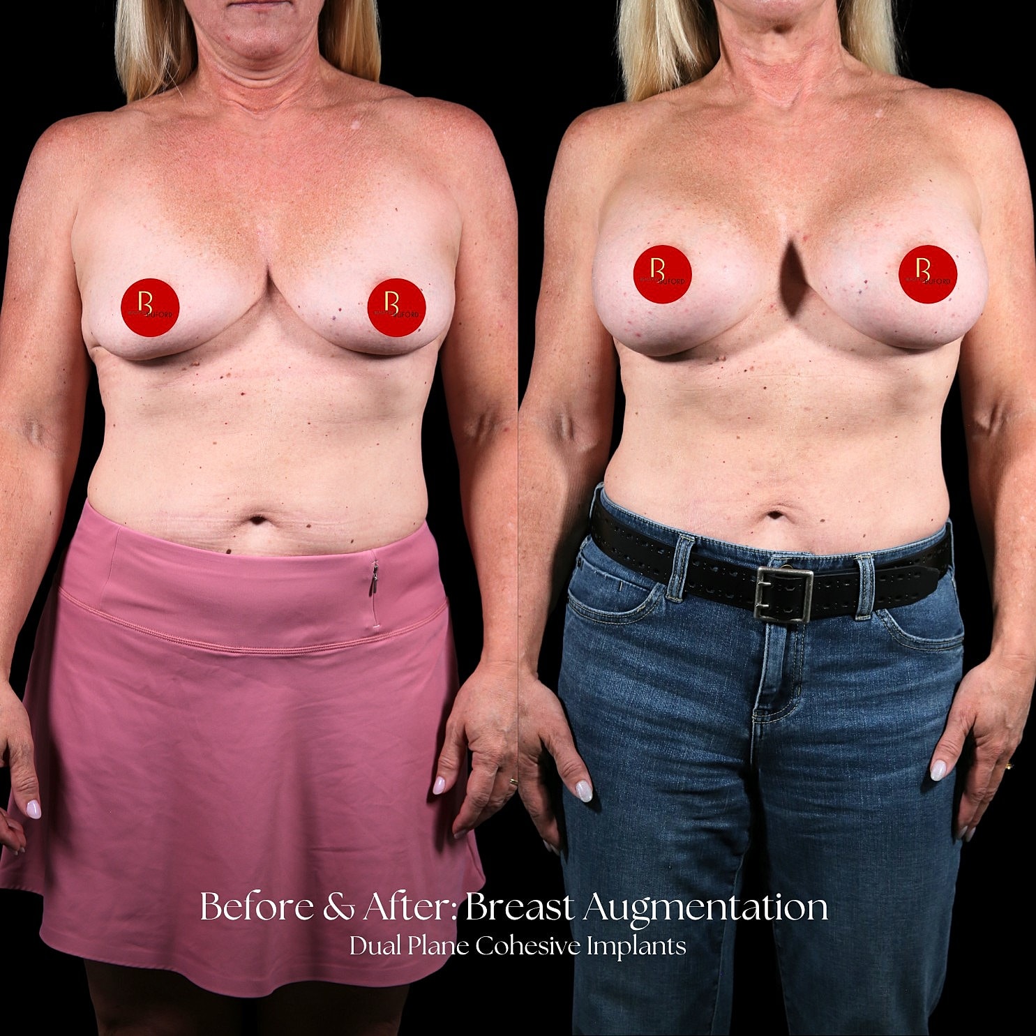 Breast Augmentation Before & After