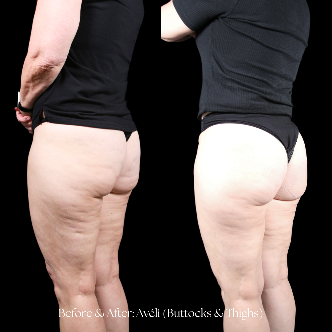 Aveli Before & After