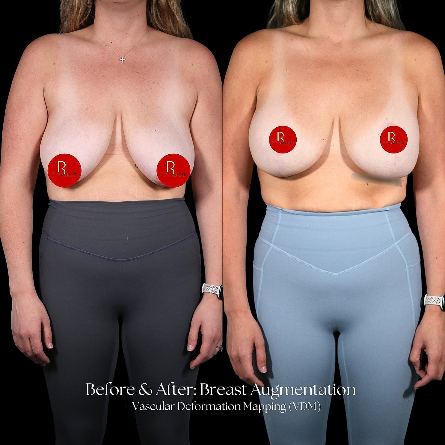 Breast augmentation before and after comparison image